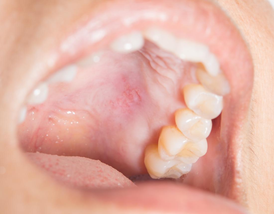 Điều gì gây ra một vết sưng trên vòm miệng?