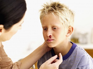 Chảy máu mũi ở trẻ em là bệnh gì, cách điều trị