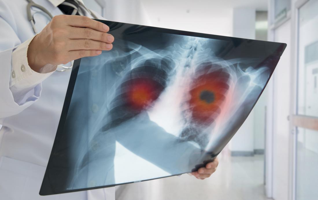 Tại sao ung thư phổi lại khó điều trị?