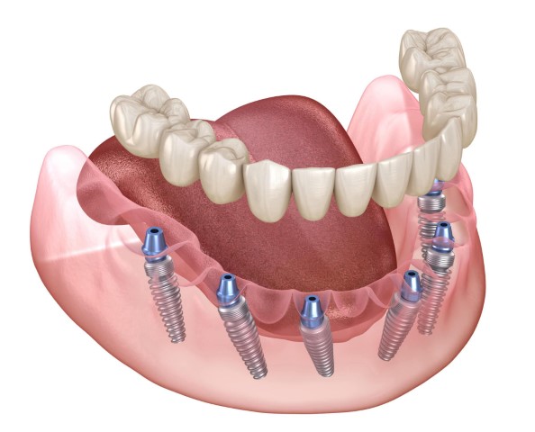 trồng răng implant có nguy hiểm không,trong rang implant co nguy hiem khong
