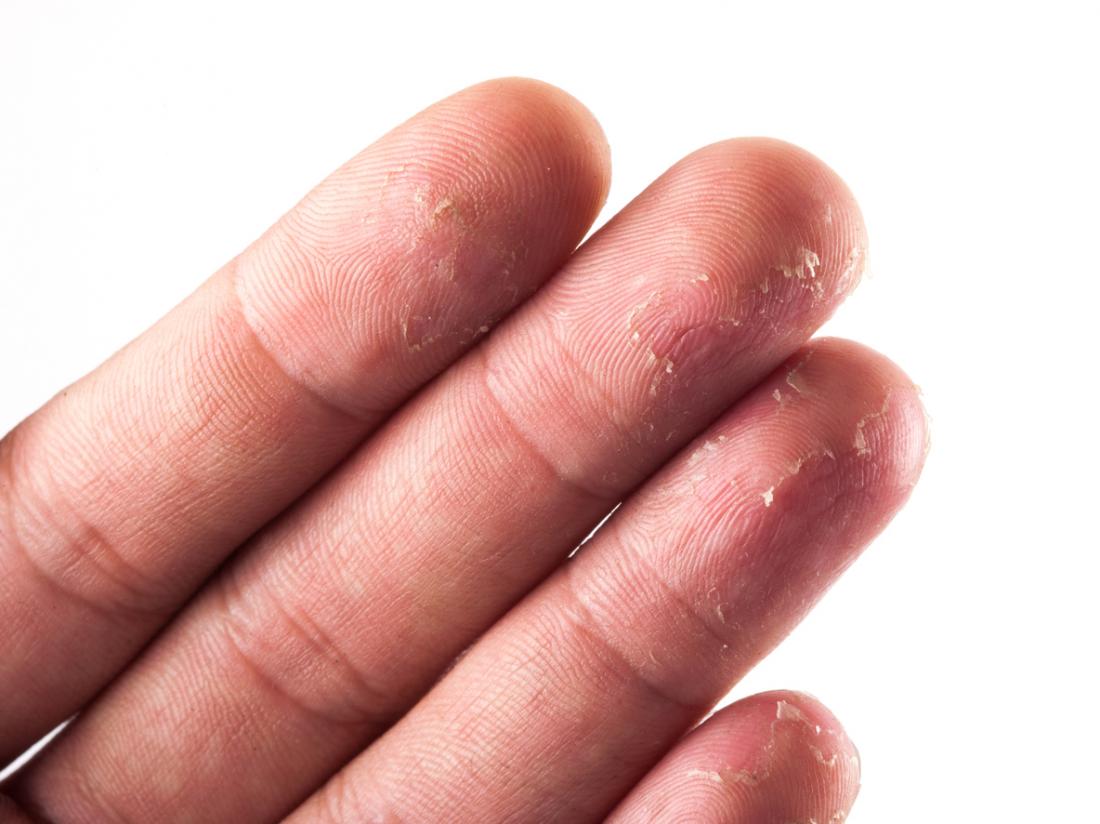 Nguyên nhân gây lột da trên đầu ngón tay?