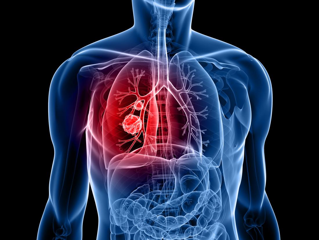Protein mới có thể giúp sớm phát hiện ung thư phổi