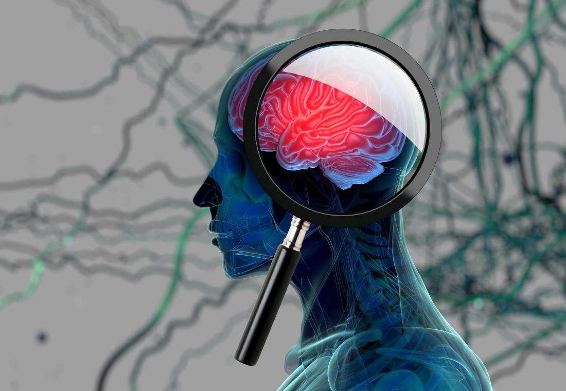 Bệnh Parkinson: Protein độc hại làm hư hại tế bào não như thế nào